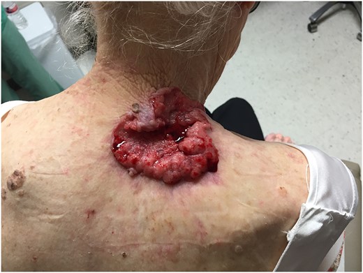 Original 7 × 6.5 cm fungated, ulcerate lesion of the right shoulder.