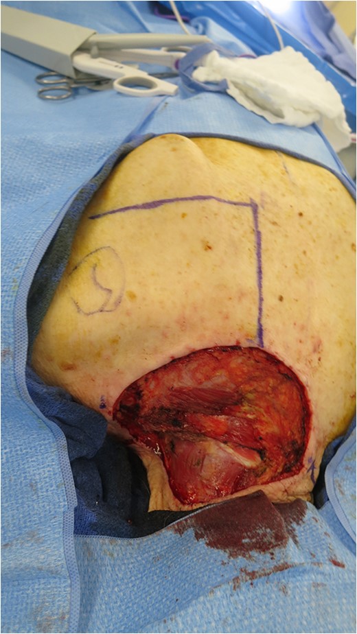 Open defect measuring 11 × 10 cm after excision of primary lesion.
