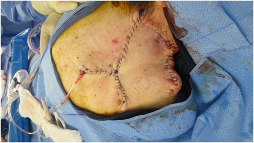Primary closure of defect with rhomboid flap, total area of 220 cm2.