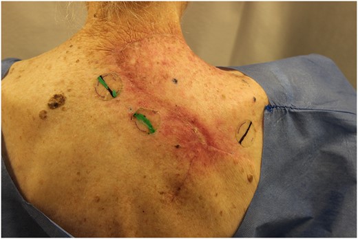 Six-week post-operative lesion after two weeks of radiation treatments.