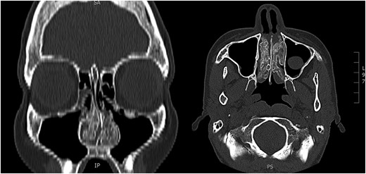 Preoperative CT. Paranasal sinuses (coronal and axial) showing bilateral inferior turbinate tumour.