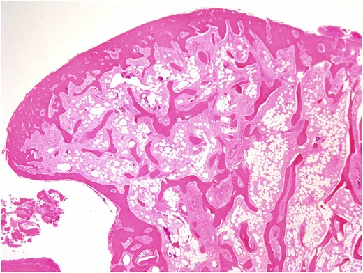 Osteoma, high-magnification photomicrograph. Scanning power photomicrograph showing disrupted pieces of multilobulated variably hyperostotic bone characterized by central anastomosing cancellous trabeculae and fibro-adipocytic interstices, surmounted by more sclerotic cortical type bone. Note the complete absence of any chondroid element (H&E stain, original magnification ×1).