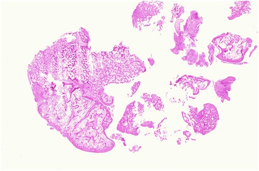 Osteoma, low-magnification photomicrograph. Low-magnification image of a protuberant bosselation emphasizing the bony zonation and total lack of haematopoietic marrow. There is neither significant osteoblastic activity nor appreciable osteoclasis (H&E stain, original magnification ×1.25).