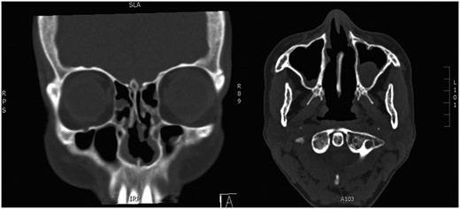 Postoperative CT. Paranasal sinuses showing patent nasal airway following bilateral inferior turbinectomies.