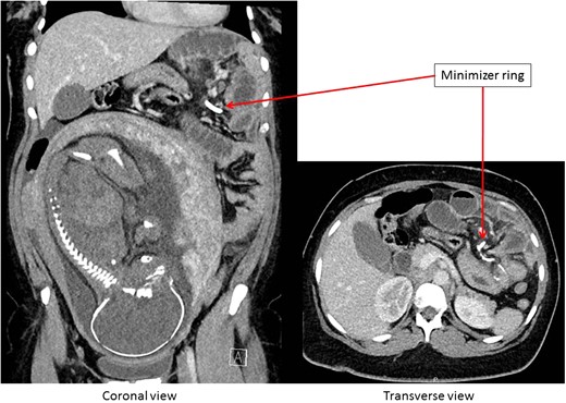 CT-scan of the abdomen showing an ileus caused by a migrated minimizer ring.