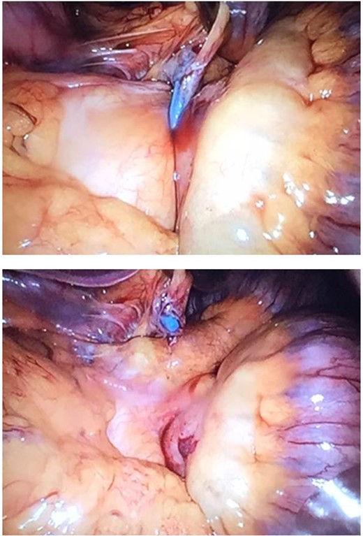 Upper picture: minimizer ring around the jejunojejunostomy. Lower picture: removal of the minimizer ring.