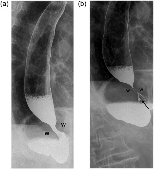 (a) Contrast swallow on Day 1 following posterior cardiopexy and 360° fundoplication demonstrating adequate passage of contrast through the wrap (W=right and left folds of the wrap). (b) A repeat contrast swallow in the same patient 24 h later revealing a hold up at the level of the wrap caused by oedema. The oesophagus above the wrap is dilated. A thin trickle of contrast (black arrow) is seen to come through the fundoplication.