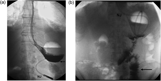 (a) An upper gastrointestinal series revealing hold up of contrast at the level of gastro-jejunostomy (black arrow), Day 7 post radical subtotal gastrectomy (b) A repeat contrast study, following dexamethasone challenge, shows good emptying with contrast reaching the jejunum (black arrow) promptly (NJ=naso-jejunal feeding tube).