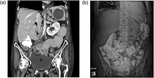 (a) CT scan of the abdomen and pelvis in a patient who underwent adhesiolysis and small bowel resection. The scan shows hold of the contrast at the level of the anastomosis (black arrow) just over the dome of the bladder (B=bladder). (b) A plain film of the abdomen, following Dexamethasone challenge, confirms the presence of contrast in the distal ileum (black arrow) and the colon (white arrow).