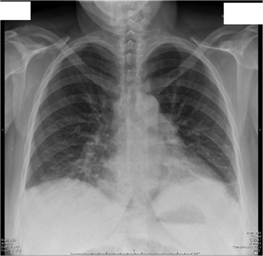Day 1 postoperative chest X-ray shows evidence of mild atelactesis.