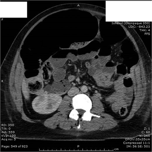 Day 2 post op CT A/P with no evidence of intra-abdominal collection/foreign body. Dilatation of entire intestine (large bowel up to 9 cm) most likely representing postsurgical ileus rather than a mechanical obstruction.