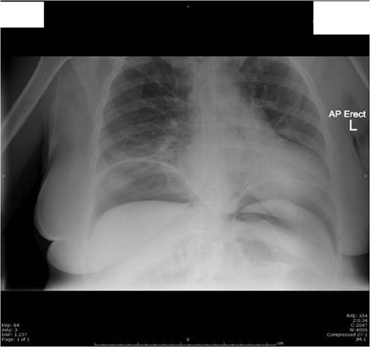 Day 4 post op chest X-ray showed a large volume of free gas under both hemi-diaphragms with multiple abnormally dilated loops of large and small bowel-features consistent with perforation of a hollow viscus.