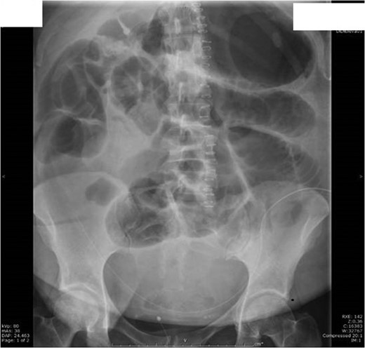 Day 3 post laparotomy she developed ileus with significant gaseous distension involving the large and small bowel; with multiple air-fluid levels on horizontal beam imaging.