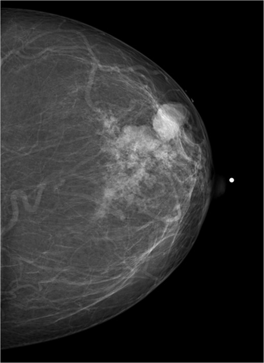 Mammogram craniocaudal view of left breast.