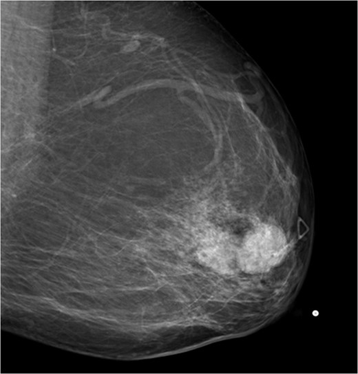 Mammogram mediolateral view of left breast showing lesion posterior to nipple BI-RADS 5.