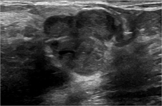 Ultrasound of left breast showing multilobulated lesion BI-RADS 4.