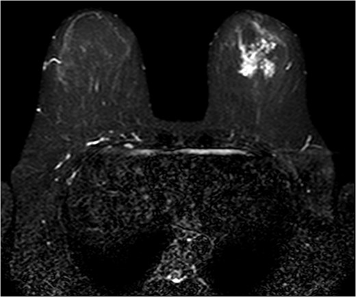 Fat suppressed breast MRI post contrast.