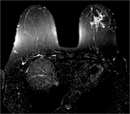 Fat suppressed breast MRI post contrast.