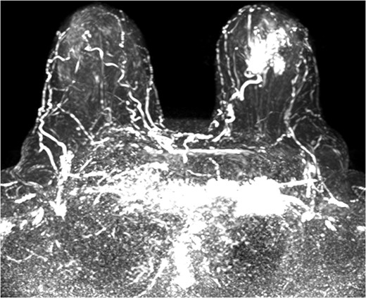 MRI reconstruction.