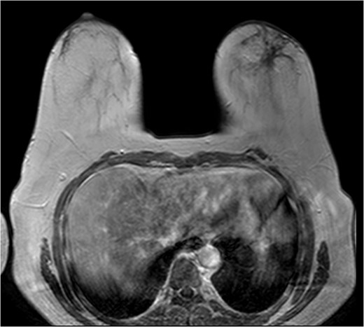 T1 weighted breast MRI BI-RADS 5.