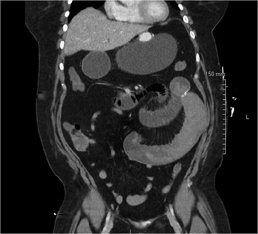 Abdominal CT demonstrating SBO with a transition point distal to the jejunojejunal anastomosis.