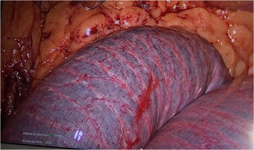 Dilated, friable small bowel of the common channel proximal to the site of obstruction with discoloration due to intraluminal clot.