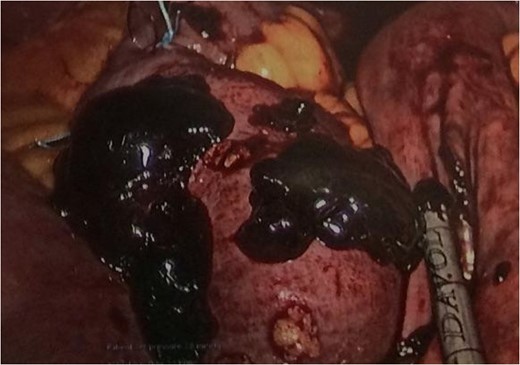 Intraluminal clot within the common channel after an enterotomy was created.