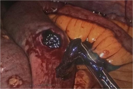 Improvement in small bowel appearance after evacuation of clot with suction and manual extraction.
