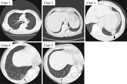 CT findings of five CMPT cases. While Cases 1, 2 and 5 present with small peripheral pulmonary nodules around 10 mm in diameter, Case 4 shows a ground-grass opacity pattern (arrow). Case 3 with mucinous colloid adenocarcinoma exhibits an irregular consolidation-like lesion, which is highly suggestive of lung cancer (arrowhead).
