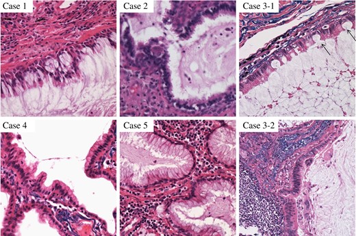 Histopathological findings of five CMPT cases, showing ciliated columnar cells with mucous lakes. Case 3 presented with mucinous colloid adenocarcinoma (bottom), as well as CMPT with typical features of goblet cells (top/arrow).