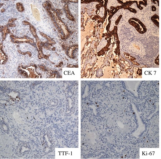 Immunohistochemical findings of Case 2, showing positive staining pattern for CEA, CK7 and TTF-1 with low Ki-67 index. CEA, carcinoembryonic antigen; CK, cytokeratin; TTF-1, thyroid transcription factor-1.