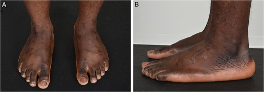 Anterior–posterior (A) and lateral views (B) of both feet. No obvious abnormalities were detected on general inspection.