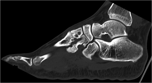 CT scan of left foot. Erosive bony changes are visible of the intermediate and lateral cuneiforms and the corresponding metacarpal bases. These erosions vary in size from 5 to 7 mm.
