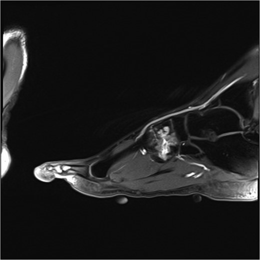 MRI angiogram of left foot. High signal in the midfoot bone around the intermediate and lateral cuneiform bones in keeping with a venous malformation.
