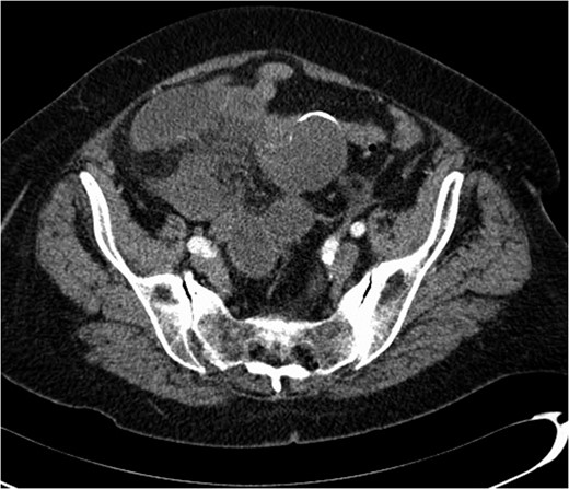 Axial CT scan showing a partially calcified structure adjacent to loops of small bowel.