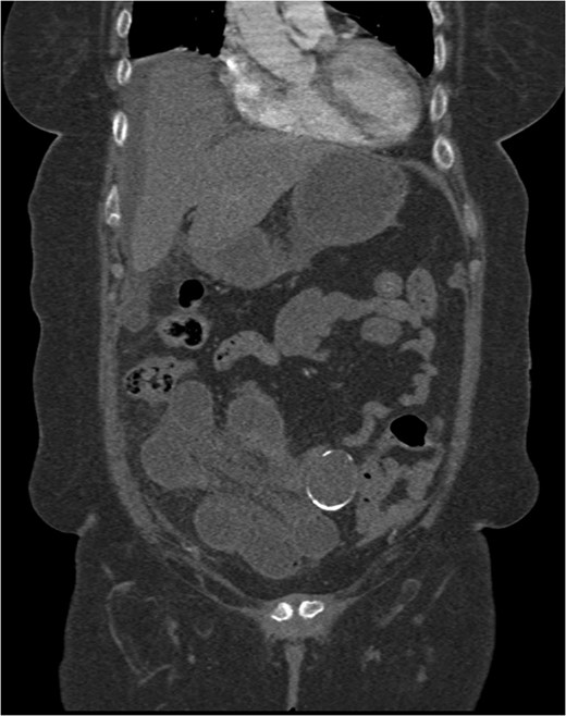 Coronal CT scan showing a partially calcified structure adjacent to loops of small bowel.