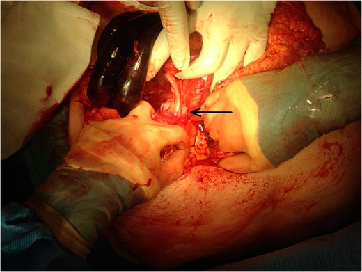 Intraoperative image black arrow pointing to intra-abdominal calcified structure. Ischaemic bowel in top left of image.