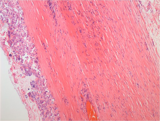 Haemolysin and eosin stain showing occasional lymphoid aggregates, smooth muscle and neurovascular bundles within the duplication cyst.