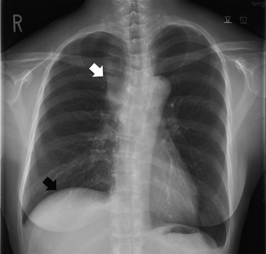 A chest X-ray on admission showed an enlarged superior mediastinum (white arrow) and right diaphragmatic elevation (black arrow).