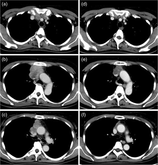 Preoperative enhanced CT of the chest (a, b, c) showed an invasive anterior mediastinal tumor, extending to bilateral brachiocephalic veins and SVC with intraluminal tumor thrombus. After induction CRT, the mediastinal tumor was shrunk and intraluminal tumor thrombus of great veins was improved (d, e, f).