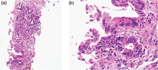 The tumor was diagnosed as thymic adenocarcinoma with enteric differentiation, with the suspicion of primary thymic carcinoma or metastatic thymic tumor from grastrointestinal cancer (a: HE stain × 40; b: HE stain × 100).