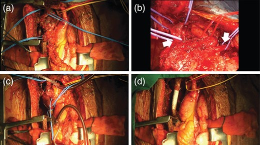 Median full sternotomy with a right TMA was performed to obtain good exposure of infraclavicular region (a). The tumor was invaded to pericardium, right upper lobe of the lung, bilateral brachiocephalic veins (white arrows), azygos vein, right phrenic nerve and SVC (b). Under a temporal veno-venous bypass between right internal jugular vein and right atrial appendage (c), SVC was reconstructed with synthetic vessel (d).