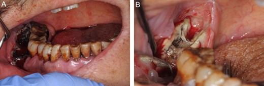 (A) The oral photograph at the initial visit, immediately after the gauze with the astringent has been removed. The maximum mouth opening is 18 mm. His gingivae are red and bloated. (B) The oral photograph after the extraction of teeth 47 and 48.