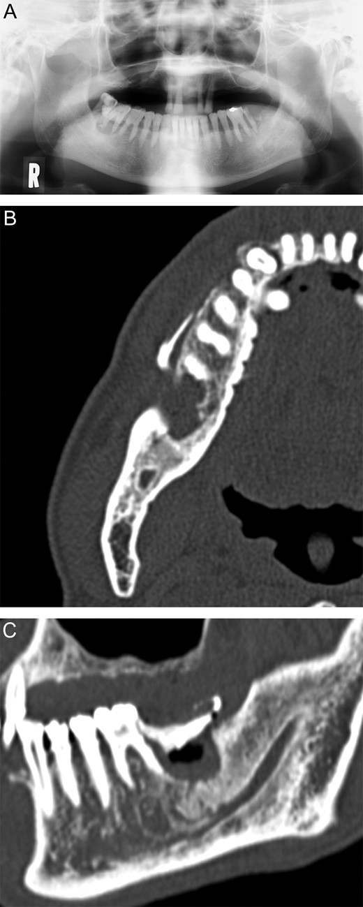(A) Panoramic radiograph on 12 June 2012. (B) Coronal view of the computed tomography images on 25 June 2012. (C) Sagittal view of the computed tomography images on 25 June 2012.