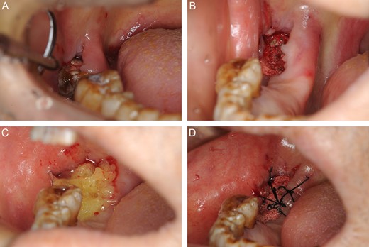 Photographs of the operative procedure. (A) Before surgery. (B) We removed necrotic bone with ultrasonic bone surgery until there was bleeding from the bone surface. (C) We placed gauze with tetracycline ointment in the socket. (D) We used 3–0 silk thread sutures to compress the gauze.