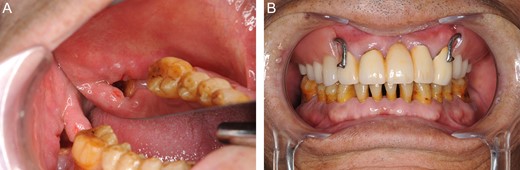 (A) Oral photograph on 18 October 2012. Formation of granulation tissue nearly covers the surface of the bone. (B) The oral photograph on 18 October 2012. We placed a bridge for upper anterior teeth 12, 11, 22 and 23, and a partial denture.