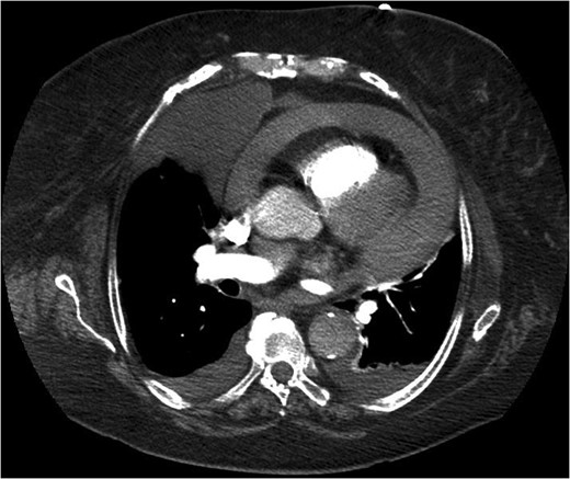 CT showing Morgagni hernia.
