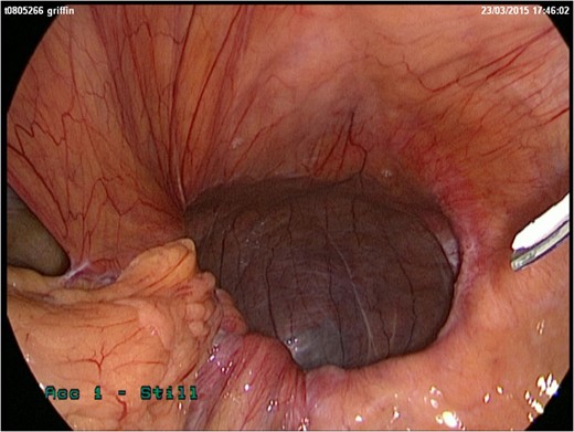 Laparoscopic image of Morgagni hernia.