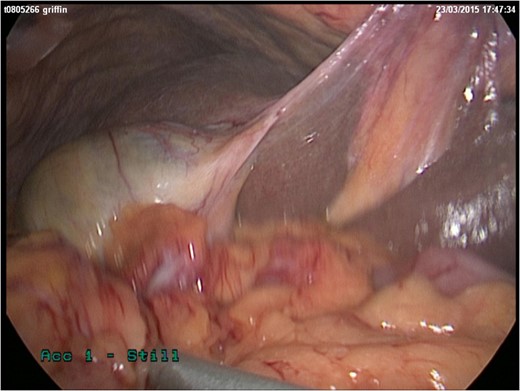 Content of Morgagni hernia being reduced.
