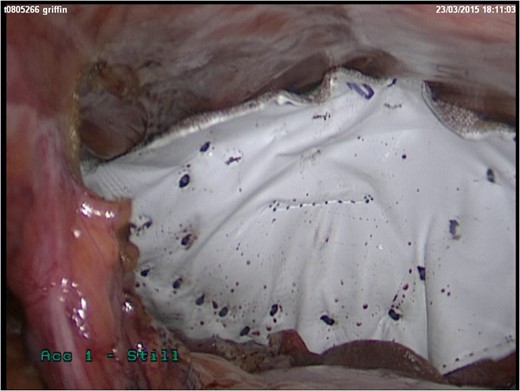Composite mesh repair of hernia defect.